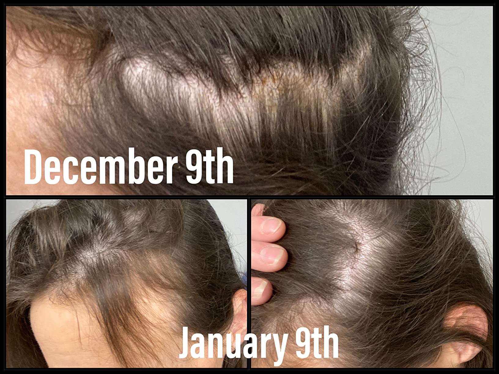 FoliGROWTH Hair Growth Supplement for Women & Men | for Thicker, Fuller Hair | Supports Thinning Hair, Backed by 20 Years of Experience in Hair Loss Treatment Clinics customer photo 2