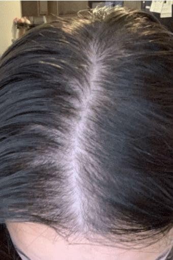 iRestore Elite - Laser Red Light Therapy for Hair Growth System - FDA Cleared Hair Loss, Hair Thinning & Alopecia Treatment for Men & Women - Laser Cap for Hair Regrowth Stimulates Denser Fuller Hair customer photo 1